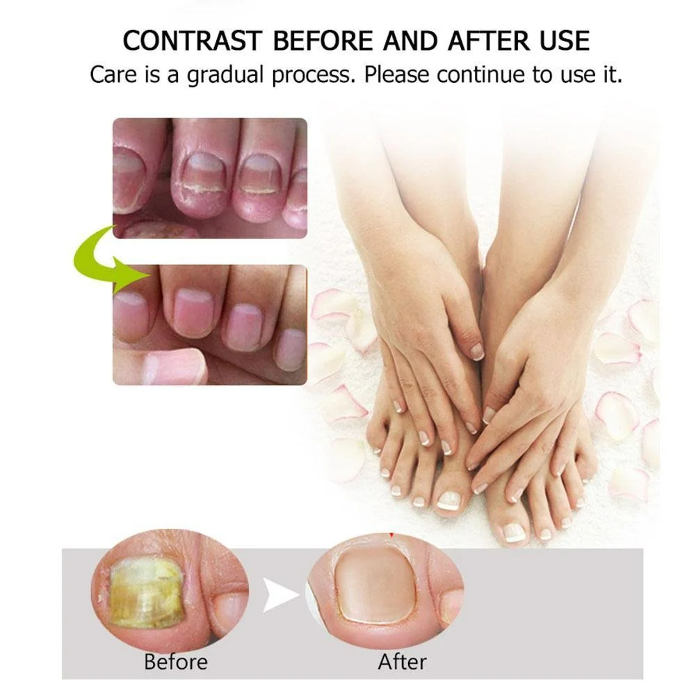 1+1 gratis | Nagelreparatie | Snelle en effectieve resultaten! - Image 4