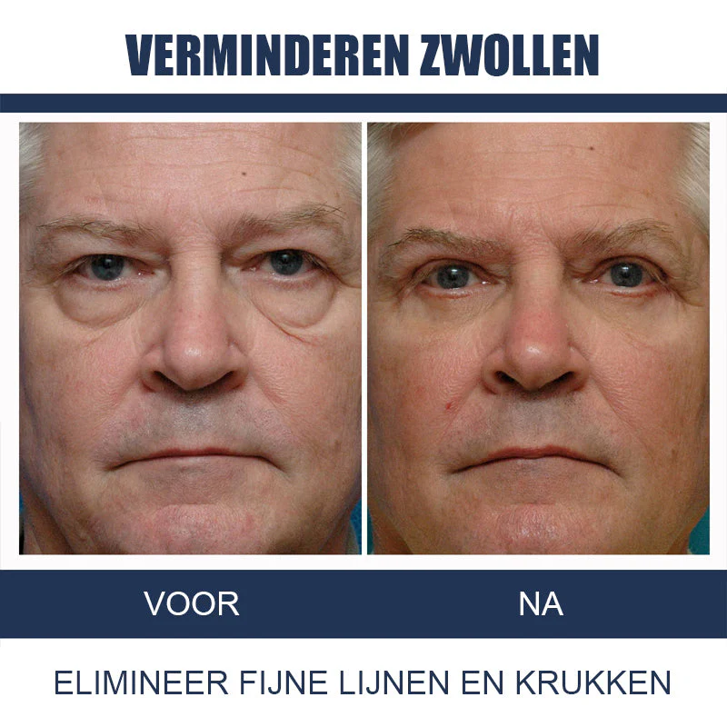 EyeRevive - Vermindert wallen en donkere kringen voor een frisse, jeugdige uitstraling | 1+2 GRATIS - Image 9